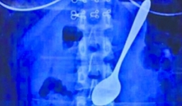 Nữ sinh nuốt chiếc thìa 14cm vào bụng khi ăn kem