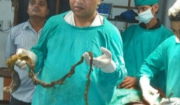 Phẫu thuật lấy búi tóc dài hơn 1,5 m trong dạ dày bé gái