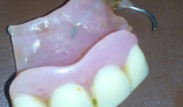 Tìm thấy 4 răng giả kèm móc sắt bị mất ở trong dạ dày