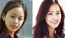 Sao Hàn đẹp lên nhờ chỉnh sửa răng