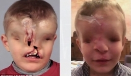 Video: Bé trai không mắt, không mũi trải qua ca phẫu thuật tái tạo khuôn mặt