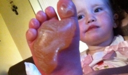 Bé gái suýt mất chân vì giẫm lên đồ chơi trong ngày nắng nóng