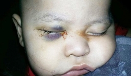 Bé 1 tuổi bị mù vì bác sĩ phẫu thuật nhầm mắt