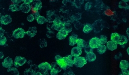 Tử vong vì 'amip ăn não' sau khi đi bơi