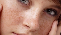 Tuyệt chiêu trị nám da hiệu quả tại nhà