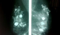 Cắt bỏ ngực vì di chứng bơm silicon từ 30 năm trước 