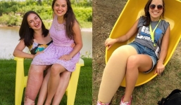 Cô gái có chân phải to gấp đôi chân trái trở thành hoa hậu