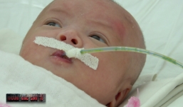 Cứu sống bé gái có ruột non và đại tràng nằm ngoài ổ bụng