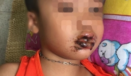 Học sinh mầm non ăn phải bột bồn cầu: nhà trường nói gì?