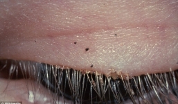 Kinh hãi phát hiện 20 con chấy trên mắt một người phụ nữ