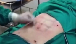 Kinh hãi với ca phẫu thuật hành xác để tạo cơ bụng 6 múi