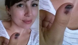 Phát hiện ung thư ác tính nhờ vết bầm trên móng tay