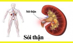 Những thói quen thường ngày gây nên bệnh sỏi thận