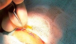 Phẫu thuật gắp con giun dài 12cm ra khỏi mí mắt người