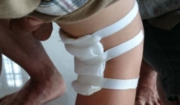 Bệnh viện lên tiếng vụ 'đau chân trái mổ nhầm chân phải'