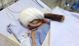 Thông tin sức khỏe bé trai sơ sinh bị đâm vào đầu