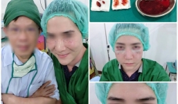 Chàng trai bị biến dạng khuôn mặt vì ham làm đẹp