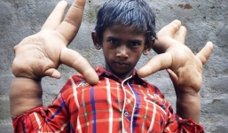 Cuộc sống thường ngày khốn khổ của cậu bé có đôi tay to như chân voi