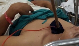  Trộm chó hung hãn bắn tên xung điện khiến dân phòng ngất xỉu