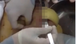 Rùng mình 'chất lạ' vàng sệt chảy ra từ ngực người phụ nữ