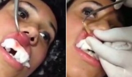 Video: Kinh hãi cảnh gắp giòi sống ra từ môi người