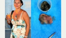 Bất ngờ phát hiện bào thai song sinh trong bụng suốt 45 năm mà không biết