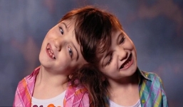 Kì diệu với cuộc sống của cặp song sinh có chung não