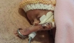 Bé sinh non có bàn tay lọt thỏm trong nhẫn cưới