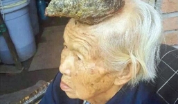 Cụ bà bât ngờ “mọc sừng” 13 cm trên đầu