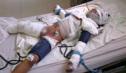 Bé gái bị mẹ tẩm xăng đốt sẽ được ghép da