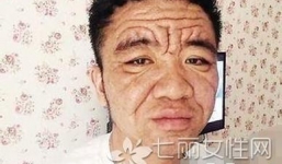 Mắc bệnh lạ, anh chàng 30 tuổi hóa ông lão 70 tuổi