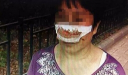 Vợ bị chồng cắn đứt mũi vì không nghe điện thoại