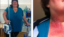 Người phụ nữ bị ung thư vú vì để điện thoại trong áo ngực?