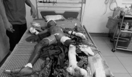 Bé trai bị đa chấn thương do đồ chơi lạ phát nổ