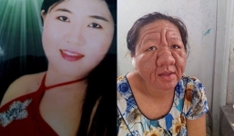 Ngỡ ngàng cô gái trẻ 29 tuổi bỗng hóa 'bà lão' 70 tuổi do lạm dụng corticoid