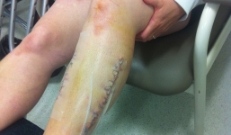 Chân trái gần như 'phát nổ' sau khi đi bộ 10km