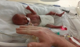 Bé gái sinh non 5 lạng và sức sống mãnh liệt 