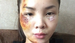 Gương mặt bầm dập do tai nạn giao thông của ca sĩ Yến Trang