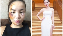 Yến Trang bức xúc bởi những lời chê bai nhan sắc sau tai nạn
