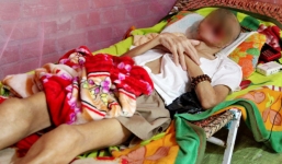 Người mắc bệnh lạ ăn mòn nửa khuôn mặt ở Tiền Giang đồng ý nhập viện