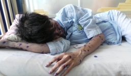 TP.HCM: Dịch thủy đậu tấn công trường học