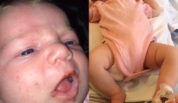 Bé sơ sinh suýt tử vong vì...được hôn