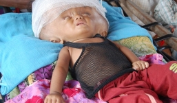 Nhói lòng trước bé gái đầu to hơn nửa mét, não chứa đầy nước