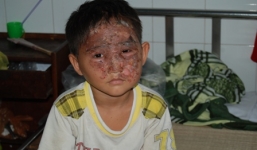 Chơi đèn lồng trung thu, bé trai bị bỏng khắp mặt