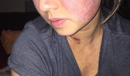 Sau ca nâng ngực, chuyên gia thẩm mỹ gốc Việt bị eczema