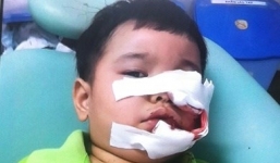 Bé trai 3 tuổi bị chó Phú Quốc cắn phải khâu 200 mũi