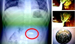 Bé trai 7 tuổi nuốt đồng xu vào bụng trong lúc mải chơi game