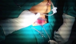 Bé trai bị tôn cứa đứt khí quản đã được cứu sống