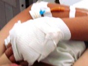 Bị xe buýt cán qua tay khi đuổi theo tên trộm