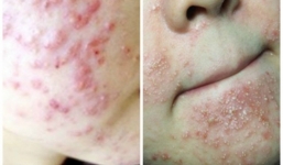 Chuyên gia khuyến cáo cách phòng dị ứng chất bảo quản sản phẩm làm đẹp